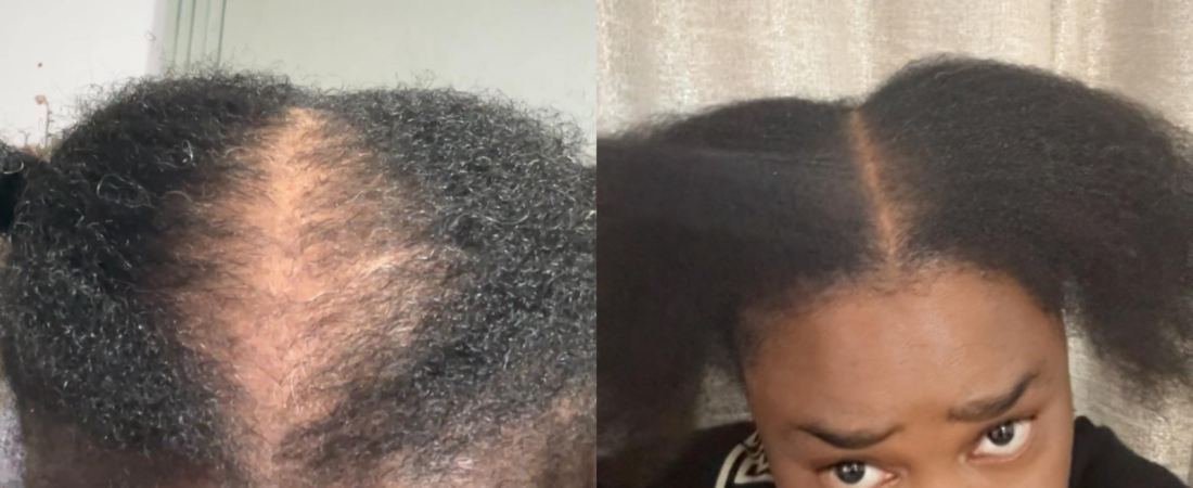 Postpartum Hair Loss: Causes, How Long It Lasts, and What Helps