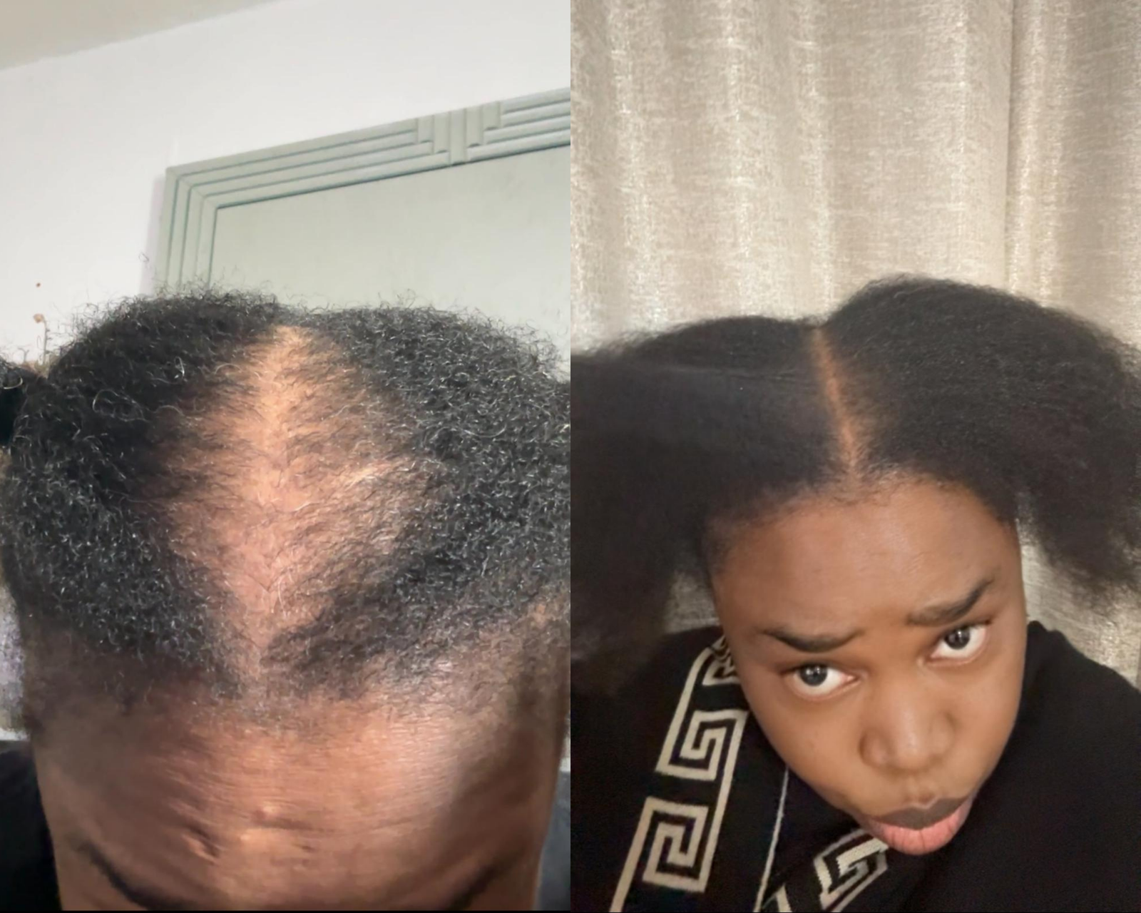 Postpartum Hair Loss: Causes, How Long It Lasts, and What Helps